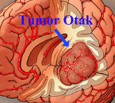 Obat Tradisional Tumor Otak